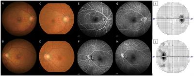 Case report: dengue fever associated acute macular neuroretinopathy